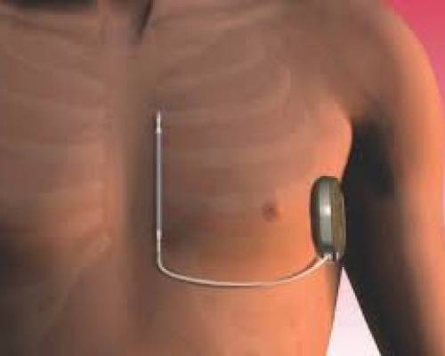 Aquest dispositiu pot prevenir aturades cardíaques en pacients d'alt risc