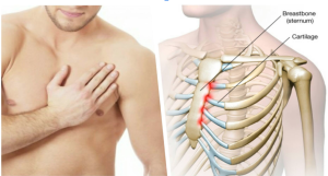 costocondritis dolor pecho pit comprar dea barato samaritan